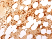 IHC testing of FFPE human bone marrow with Transferrin Receptor / CD71 antibody (clone TFRC/1817). Required HIER: boil tissue sections in 10mM Tris with 1mM EDTA, pH 9, for 10-20 min followed by cooling at RT for 20 min.