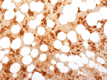 IHC testing of FFPE human bone marrow with CD71 / Transferrin Receptor antibody (clone TFRC/1818). Required HIER: boil tissue sections in 10mM Tris with 1mM EDTA, pH 9, for 10-20 min followed by cooling at RT for 20 min.~