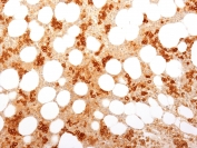 IHC testing of FFPE human bone marrow with CD71 / Transferrin Receptor antibody (clone TFRC/1818). Required HIER: boil tissue sections in 10mM Tris with 1mM EDTA, pH 9, for 10-20 min followed by cooling at RT for 20 min.