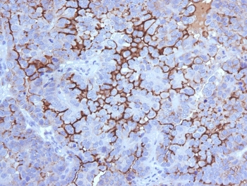 IHC testing of FFPE human ovarian carcinoma with MUC16 antibody (clone 5E11). Required HIER: steam section in pH 9 10mM Tris with 1mM EDTA for 20 min and allow to cool prior to testing.