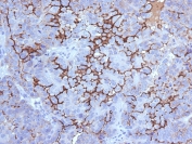IHC testing of FFPE human ovarian carcinoma with MUC16 antibody (clone 5E11). Required HIER: steam section in pH 9 10mM Tris with 1mM EDTA for 20 min and allow to cool prior to testing. Data courtesy of Dr. Leonor David, IPATIMUP and Medical Faculty University of Porto, Portugal.