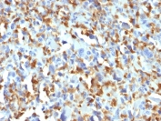 IHC testing of FFPE human histiocytoma with Factor XIIIa antibody (clone F13A1/1683). Required HIER: boil tissue sections in 10mM citrate buffer, pH 6, for 10-20 min.