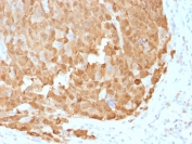 IHC testing of FFPE human melanoma with S100A1 antibody (clone S100A1/1942). Required HIER: steam sections in 10mM citrate buffer, pH 6, for 10-20 min followed by cooling.
