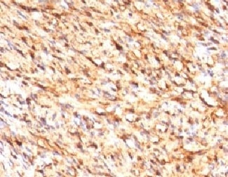 IHC testing of FFPE human schwanoma with S100 beta antibody (clone S100B/1012). Required HIER: boil tissue sections in pH 9 10mM Tris with 1mM EDTA for 10-20 min followed by cooling at RT for 20 min.~