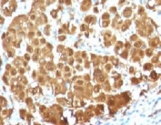 IHC testing of FFPE human melanoma with S100 beta antibody (clone S100B/1012). Required HIER: boil tissue sections in pH 9 10mM Tris with 1mM EDTA for 10-20 min followed by cooling at RT for 20 min.