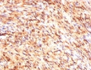 IHC testing of FFPE human schwanoma with S100B antibody (clone PS1B1-1). Required HIER: boil tissue sections in pH 9 10mM Tris with 1mM EDTA for 10-20 min followed by cooling at RT for 20 min.
