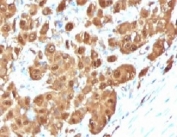 IHC testing of FFPE human melanoma with S100B antibody (clone PS1B1-1). Required HIER: boil tissue sections in pH 9 10mM Tris with 1mM EDTA for 10-20 min followed by cooling at RT for 20 min.