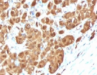 IHC testing of FFPE human melanoma with S100B antibody (clone PS1B1-1). Required HIER: boil tissue sections in pH 9 10mM Tris with 1mM EDTA for 10-20 min followed by cooling at RT for 20 min.~