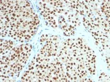 IHC testing of FFPE human melanoma with SOX10 antibody (clone SOX10/991). Required HIER: boil tissue sections in pH 9 10mM Tris with 1mM EDTA for 10-20 min followed by cooling at RT for 20 min.
