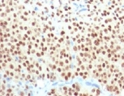 IHC testing of FFPE melanoma with SOX10 antibody (clone SBX10-1). Required HIER: boil sections in pH 9 10mM Tris with 1mM EDTA for 10-20 minutes, followed by cooling at RT for 20 minutes, prior to staining.