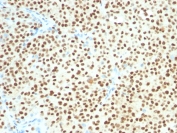 IHC testing of FFPE human melanoma with SOX-10 antibody (clone SOX10/1074). Required HIER: boil tissue sections in 10mM citrate buffer, pH 6, for 10-20 min followed by cooling at RT for 20 min.