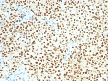 IHC testing of FFPE human melanoma with SOX-10 antibody (clone SOX10/1074). Required HIER: boil tissue sections in 10mM citrate buffer, pH 6, for 10-20 min followed by cooling at RT for 20 min.~