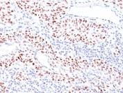 IHC: Formalin-fixed, paraffin-embedded human bladder carcinoma stained with TP53 antibody (TRP/816). Required HIER: boil tissue sections in 10mM Citrate buffer, pH 6.0, for 10-20 min followed by cooling at RT for 20 min.
