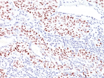 IHC: Formalin-fixed, paraffin-embedded human bladder carcinoma stained with TP53 antibody (TRP/816). Required HIER: boil tissue sections in 10mM Citrate buffer, pH 6.0, for 10-20 min followed by cooling at RT for 20 min.~