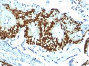IHC testing of FFPE human colon carcinoma with recombinant p53 antibody (clone TP53/1799R). Required HIER: boil tissue sections in 10mM citrate buffer, pH 6, for 10-20 min.