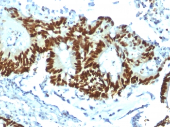 IHC testing of FFPE human colon carcinoma with recombinant p53 antibody (clone TP53/1799R). Required HIER: boil tissue sections in 10mM citrate buffer, pH 6, for 10-20 min.~