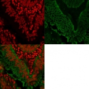 Immunofluorescent staining of FFPE human colorectal carcinoma with anti-EpCAM antibody (green) and Reddot nuclear stain (red).