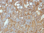 IHC testing of FFPE human hepatocellular carcinoma and anti-EpCAM antibody (clone EGP40/1372). Required HIER: steam sections in pH 9 10mM Tris with 1mM EDTA for 10-20 min.