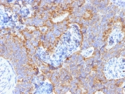 IHC staining of FFPE human colon with CEA antibody (clone C66/1291). HIER: boil tissue sections in pH 9 10mM Tris with 1mM EDTA for 10-20 min and allow to cool before testing.