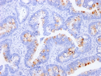 IHC staining of FFPE human colon with CEA antibody (clone C66/1291). HIER: boil tissue sections in pH 9 10mM Tris with 1mM EDTA for 10-20 min and allow to cool before testing.~