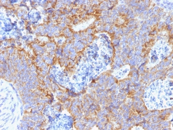 IHC staining of FFPE human colon with CEA antibody (clone C6