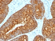 IHC testing of FFPE human colon carcinoma with MAML3 antibody (clone MAML3/1303). Staining of FFPE tissue requires boiling sections in 10mM Tris with 1mM EDTA, pH9, for 10-20 min followed by cooling at RT for 20 min.