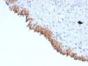 IHC testing of FFPE human bladder carcinoma with MAML2 antibody (clone MAML2/1302). Staining of FFPE tissue requires boiling sections in 10mM Tris with 1mM EDTA, pH9, for 10-20 min followed by cooling at RT for 20 min.