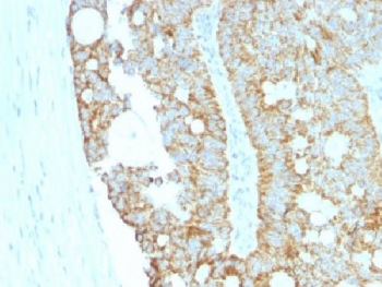 IHC testing of FFPE human colon carcinoma with MAML2 antibody (clone MAML2/1302). Staining of FFPE tissue requires boiling sections in 10mM Tris with 1mM EDTA, pH9, for 10-20 min followed by cooling at RT for 20 min.