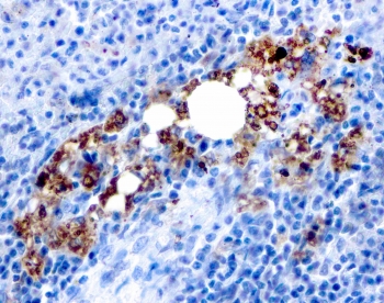 IHC testing of FFPE human spleen with recombinant TRAcP antibody (clone rACP5/1070). Required HIER: boil tissue sections in 10mM citrate buffer, pH 6.0, for 10-20 min followed by cooling at RT for 20 min.~