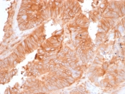 IHC testing of FFPE human colon carcinoma stained with recombinant Beta-2-Microglobulin antibody (rB2M/961). Required HEIR: boil tissue sections in pH 9 10mM Tris with 1mM EDTA for 10-20 min followed by cooling at RT for 20 min.