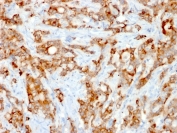 IHC testing of FFPE human lung carcinoma stained with recombinant Beta-2-Microglobulin antibody (rB2M/961). Required HEIR: boil tissue sections in pH 9 10mM Tris with 1mM EDTA for 10-20 min followed by cooling at RT for 20 min.