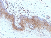 IHC testing of FFPE human cervical carcinoma stained with recombinant Beta-2-Microglobulin antibody (rB2M/961). Required HEIR: boil tissue sections in pH 9 10mM Tris with 1mM EDTA for 10-20 min followed by cooling at RT for 20 min.