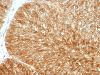IHC testing of FFPE human bladder carcinoma stained with recombinant B2M antibody (B2M/1857R). Required HEIR: boil tissue sections in 10mM citrate buffer, pH 6.0, for 10-20 min followed by cooling at RT for 20 min.