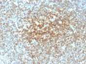 IHC testing of human follicular lymphoma with recombinant Bcl2 antibody (rBCL2/782). HIER: boil tissue sections in 1mM EDTA, pH 8, for 10-20 min followed by cooling at RT for 20 min.