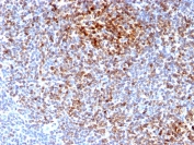 IHC testing of FFPE human follicular lymphoma with recombinant Bcl-2 antibody (clone BCL2/2210R). HIER: boil tissue sections in 1mM EDTA buffer, pH 8, for 10-20 min followed by cooling at RT for 20 min.