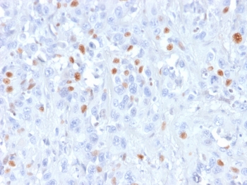 IHC testing of human urothelial carcinoma with recombinant p21 antibody (rCIP1/823). Required HIER: boil tissue sections in pH 9 10mM Tris w
