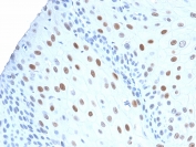 IHC testing of human urothelial carcinoma with recombinant CDNK1A antibody (CIP1/2275R). Required HIER: boil tissue sections in pH 9 10mM Tris with 1mM EDTA for 10-20 min followed by cooling at RT for 20 min.