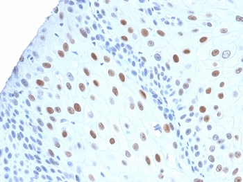 IHC testing of human urothelial carcinoma with recombinant CDNK1A antibody (CIP1/2275R). Required HIER: boil tissue sections in pH 9 10mM Tris with 1mM EDTA for 10-20 min followed by cooling at RT for 20 min.~