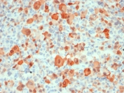 IHC testing of FFPE human melanoma with recombinant S100B antibody (clone rS100B/1896). HIER: steam sections in pH 9 10mM Tris with 1mM EDTA for 10-20 min.