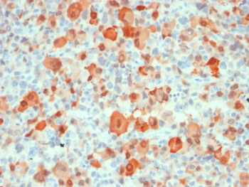 IHC testing of FFPE human melanoma with recombinant S100B antibody (clone rS100B/18