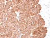 IHC testing of FFPE human basal cell carcinoma and recombinant EpCAM antibody (clone EGP40/2041R). Required HIER: boil tissue sections in pH 9 10mM Tris with 1mM EDTA for 10-20 min followed by cooling at RT for 20 min.