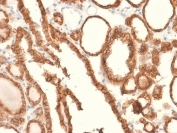 IHC testing of FFPE human thyroid carcinoma and recombinant EpCAM antibody (clone EGP40/2041R). Required HIER: boil tissue sections in pH 9 10mM Tris with 1mM EDTA for 10-20 min followed by cooling at RT for 20 min.