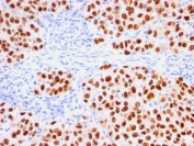 IHC testing of FFPE human melanoma with recombinant SOX10 antibody (clone rSOX10/1074). Required HIER: boil tissue sections in 10mM citrate buffer, pH 6, for 10-20 min followed by cooling at RT for 20 min.