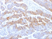IHC testing of formalin-fixed, paraffin-embedded human colon carcinoma with recombinant E-Cadherin antibody (clone rCDH1/1525). Required HIER: boil tissue sections in pH 9 10mM Tris with 1mM EDTA for 10-20 min followed by cooling at RT for 20 min.