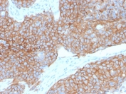 Formalin-fixed, paraffin-embedded human colon carcinoma stained with recombinant E-Cadherin antibody (clone CDH1/2208R). HIER: boil tissue sections in pH 9 10mM Tris with 1mM EDTA for 10-20 min followed by cooling at RT for 20 min.