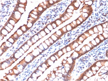 IHC testing of FFPE human small intestine carcinoma with recombinant Villin antibody (clone rVIL1/1325). Required HIER: boil tissue sections in pH9 EDTA buffer, for 10-20 min followed by cooling at RT for 20 min.~