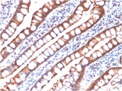 IHC testing of FFPE human small intestine carcinoma with recombinant Villin antibody (clone rVIL1/1325). Required HIER: boil tissue sections in pH9 EDTA buffer, for 10-20 min followed by cooling at RT for 20 min.