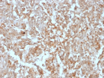 IHC testing of FFPE human gastrointestinal stromal tumor (GIST) with ANO1 antibody (clone rDG1/447). Required HIER: boil tissue sections in pH 9 10mM Tris with 1mM EDTA for 10-20 min followed by cooling at RT for 20 min.~
