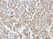 IHC testing of FFPE human gastrointestinal stromal tumor (GIST) with ANO1 antibody (clone rDG1/447). Required HIER: boil tissue sections in pH 9 10mM Tris with 1mM EDTA for 10-20 min followed by cooling at RT for 20 min.
