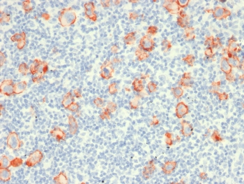 IHC testing of FFPE Hodgkin's Lymphoma with recombinant CD30 antibody (clone rCD30/412). Required HIER: boil tissue sections in 1mM EDTA, pH 7.5-8.5, for 10-20 min followed by cooling at RT for 20 min.~